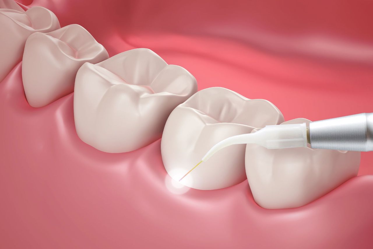 terapia laser dentista